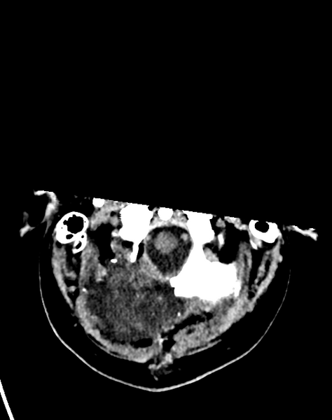 File:Cerebellar infarct due to vertebral artery dissection with posterior fossa decompression (Radiopaedia 82779-97033 Axial non-contrast 5).png