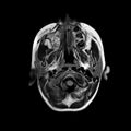 Cerebral abscess post cardiac surgery (Radiopaedia 27244-27420 Axial FLAIR 1).jpg