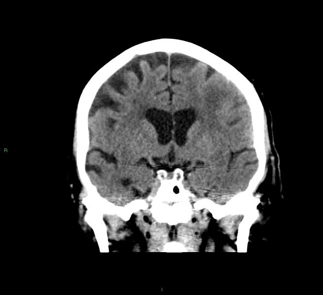 File:Cerebral amyloid angiopathy-associated lobar intracerebral hemorrhage (Radiopaedia 58376-65511 Coronal non-contrast 39).jpg