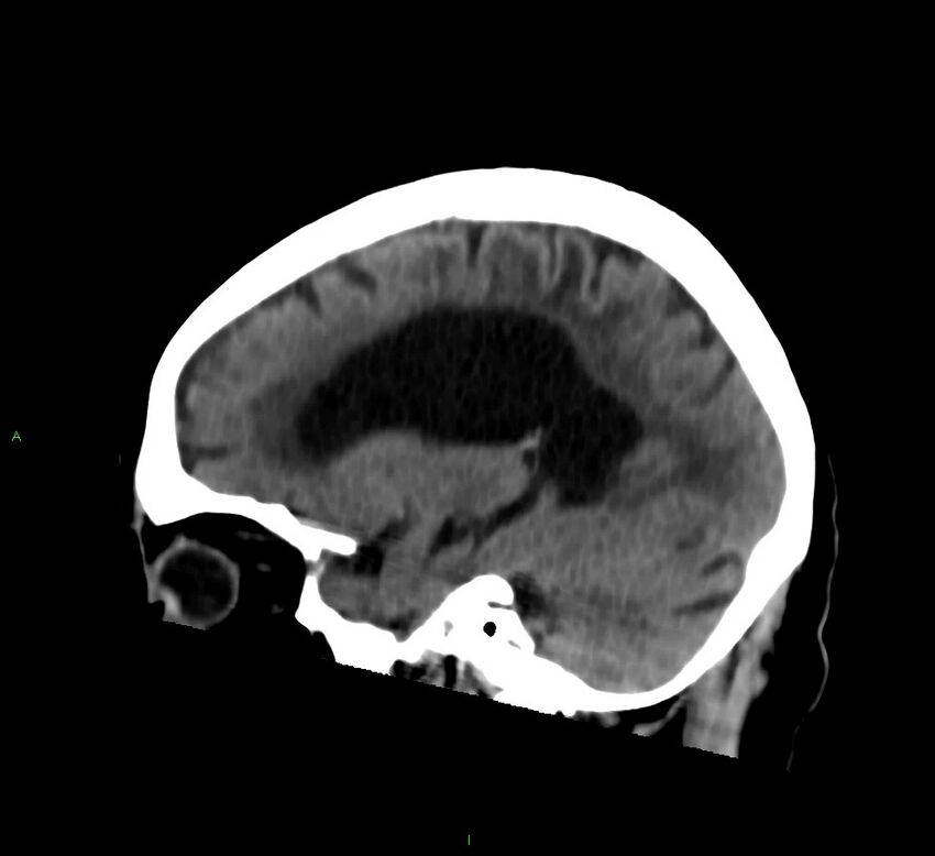 Cerebral amyloid angiopathy-associated lobar intracerebral hemorrhage (Radiopaedia 58376-65513 C 46).jpg
