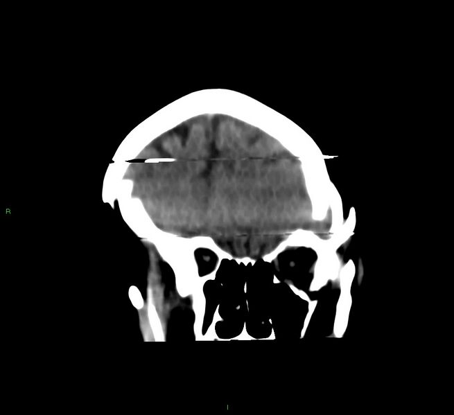 File:Cerebral amyloid angiopathy-associated lobar intracerebral hemorrhage (Radiopaedia 58377-65514 Coronal non-contrast 50).jpg
