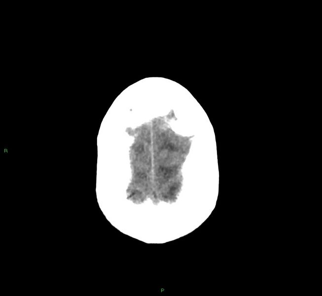 File:Cerebral amyloid angiopathy-associated lobar intracerebral hemorrhage (Radiopaedia 58530-65688 Axial non-contrast 6).jpg