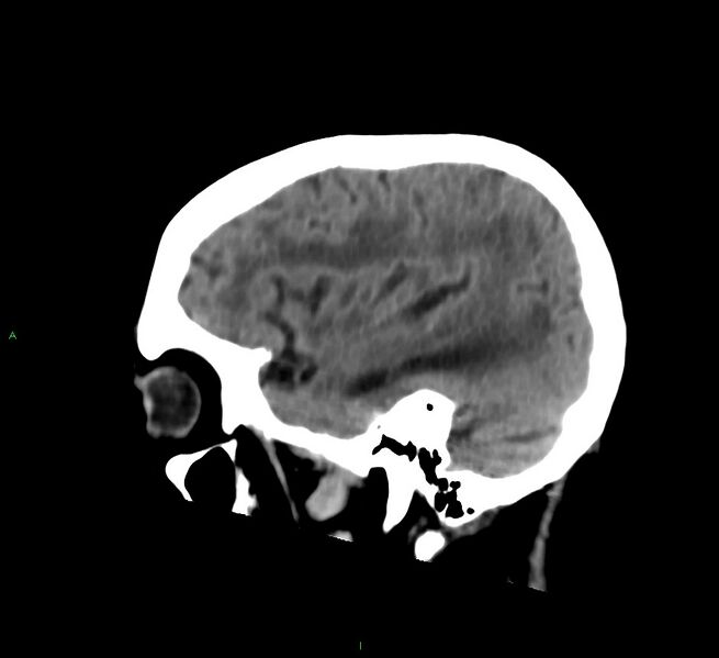 File:Cerebral amyloid angiopathy-associated lobar intracerebral hemorrhage (Radiopaedia 58530-65688 C 14).jpg