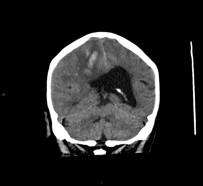 File:Cerebral amyloid angiopathy-associated lobar intracerebral hemorrhage (Radiopaedia 58560-65723 Coronal non-contrast 27).jpg
