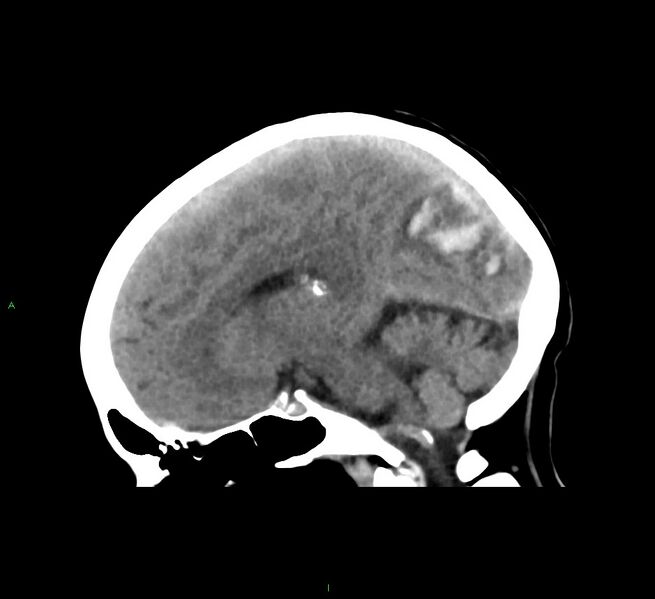File:Cerebral amyloid angiopathy-associated lobar intracerebral hemorrhage (Radiopaedia 58563-65727 C 26).jpg
