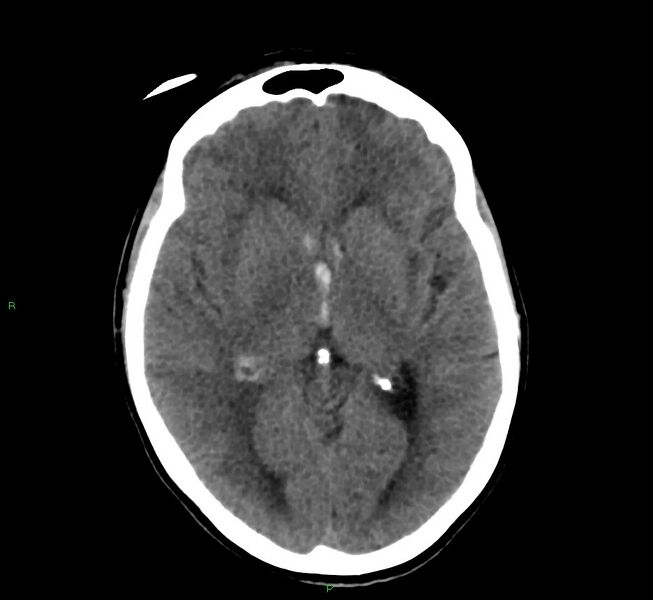 File:Cerebral amyloid angiopathy-associated lobar intracerebral hemorrhage (Radiopaedia 58566-65730 Axial non-contrast 28).jpg