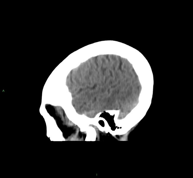 File:Cerebral amyloid angiopathy-associated lobar intracerebral hemorrhage (Radiopaedia 58566-65730 C 43).jpg