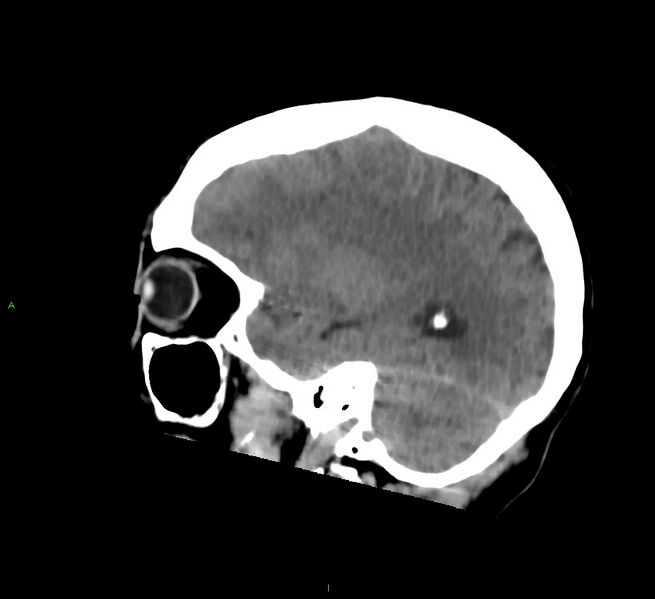 File:Cerebral amyloid angiopathy-associated lobar intracerebral hemorrhage (Radiopaedia 58756-65977 C 41).jpg