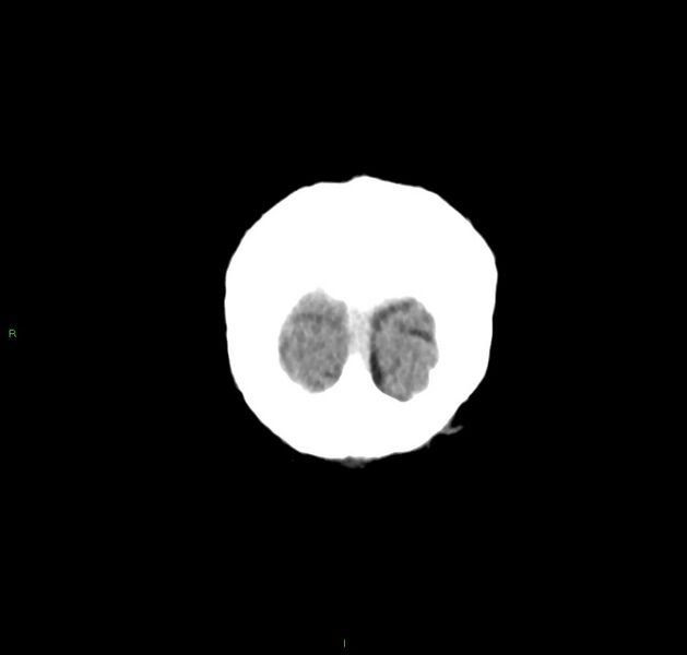 File:Cerebral amyloid angiopathy-associated lobar intracerebral hemorrhage (Radiopaedia 59356-66716 Coronal non-contrast 6).jpg