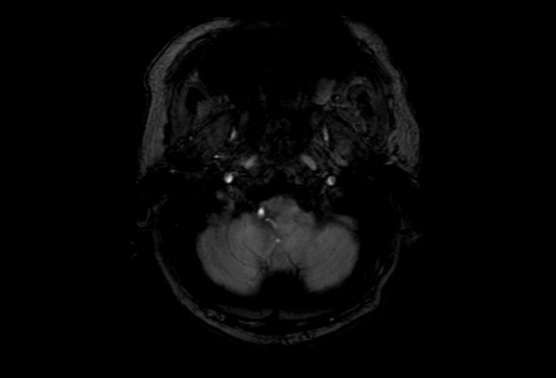 File:Cerebral amyloid angiopathy (Radiopaedia 86671-102792 Axial Gradient Echo 52).jpg