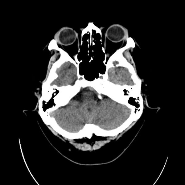 File:Cerebral arteriovenous malformation (Radiopaedia 43729-47189 Axial non-contrast 6).jpg