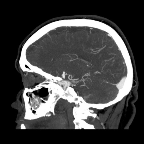 File:Cerebral arteriovenous malformation (Radiopaedia 43729-47189 D 19).jpg