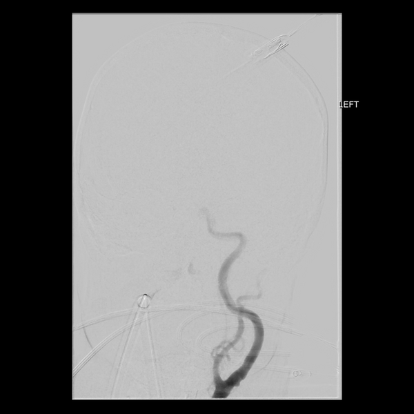 File:Cerebral arteriovenous malformation with lobar hemorrhage (Radiopaedia 44725-48513 LT CCA IC 8).png