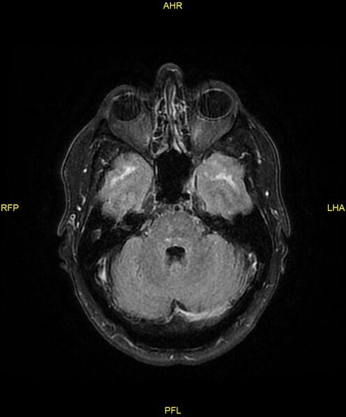 File:Cerebral autosomal dominant arteriopathy with subcortical infarcts and leukoencephalopathy (CADASIL) (Radiopaedia 86108-102054 Axial FLAIR 9).jpg