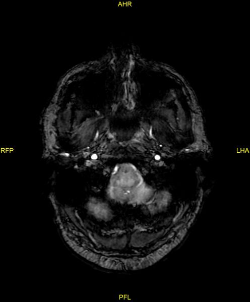 File:Cerebral autosomal dominant arteriopathy with subcortical infarcts and leukoencephalopathy (CADASIL) (Radiopaedia 86108-102054 Axial SWI 14).jpg