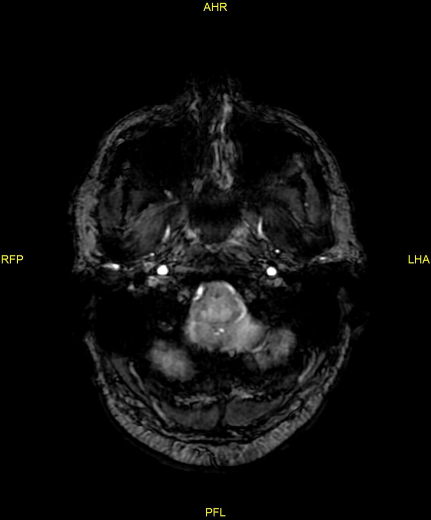 Cerebral autosomal dominant arteriopathy with subcortical infarcts and leukoencephalopathy (CADASIL) (Radiopaedia 86108-102054 Axial SWI 14).jpg