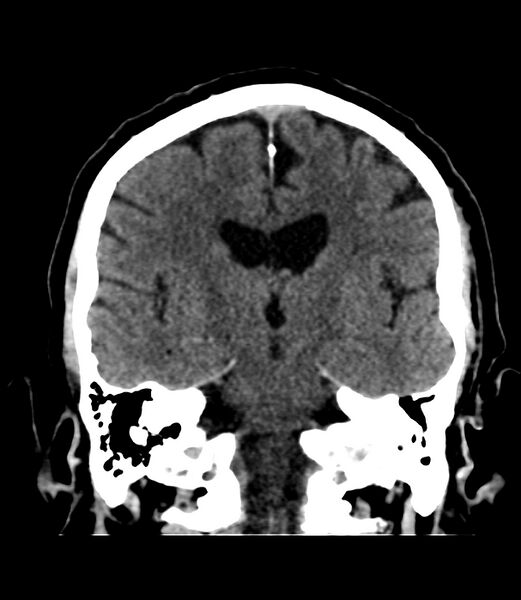 File:Cerebral dural venous sinus thrombosis (Radiopaedia 86514-102575 Coronal non-contrast 26).jpg