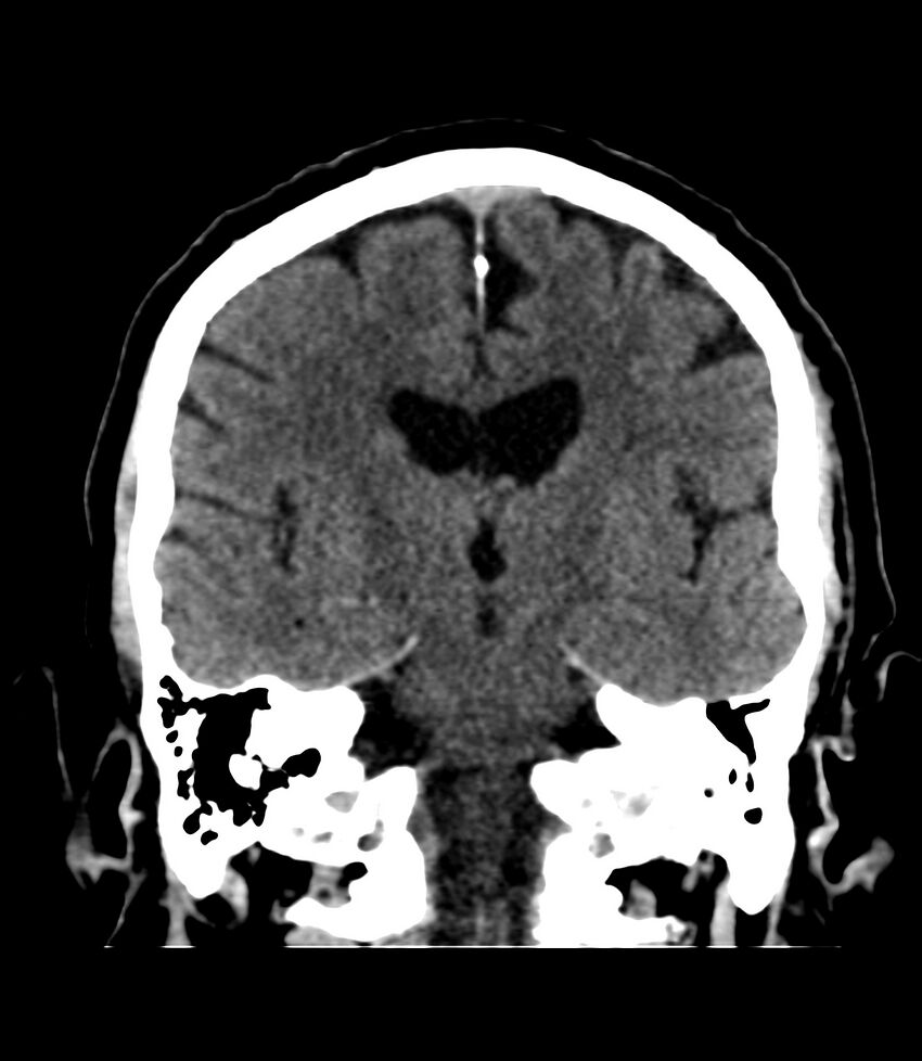 Cerebral dural venous sinus thrombosis (Radiopaedia 86514-102575 Coronal non-contrast 26).jpg