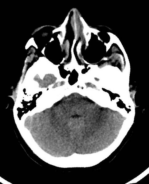 File:Cerebral edema due to severe hyponatremia (Radiopaedia 89826-106938 Axial non-contrast 27).jpg