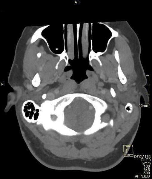 File:Cerebral venous sinus thrombosis (Radiopaedia 91329-108965 Axial venogram 11).jpg