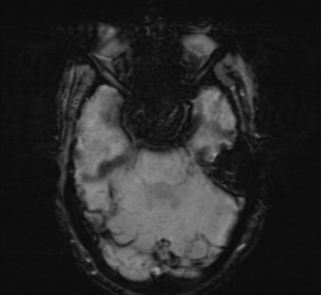 File:Cerebral venous thrombosis (Radiopaedia 71207-81504 Axial SWI 14).jpg