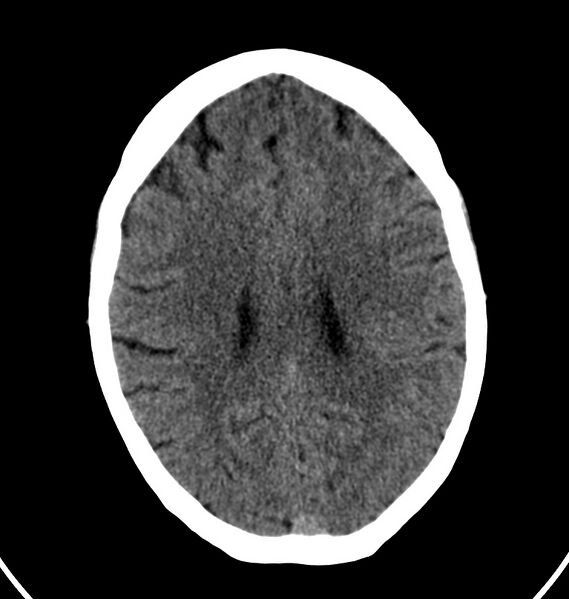 File:Cerebral venous thrombosis - CT only (Radiopaedia 41031-43778 Axial non-contrast 29).jpg