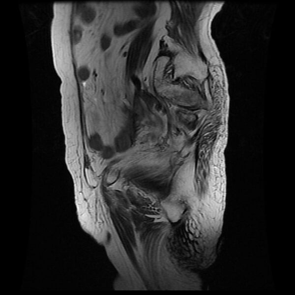 File:Cervical carcinoma (Radiopaedia 78847-91705 Sagittal T2 4).jpg