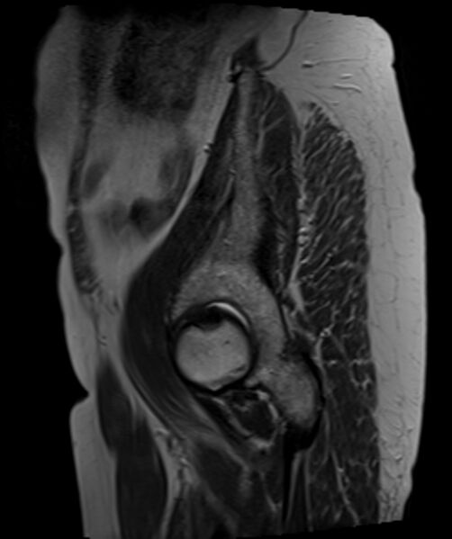 File:Cervical carcinoma (Radiopaedia 88312-104943 Sagittal T2 3).jpg