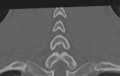 Cervical disc replacement (Radiopaedia 37383-39205 Coronal bone window 48).png