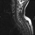 Cervical dural CSF leak on MRI and CT treated by blood patch (Radiopaedia 49748-54995 Sagittal T2 10).png