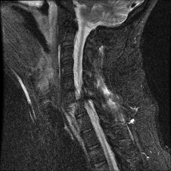 File:Cervical fracture and dislocation with locked facet (Radiopaedia 31837-32781 Sagittal STIR 11).jpg