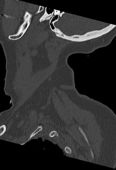File:Cervical spine ACDF loosening (Radiopaedia 48998-54070 Sagittal bone window 14).png