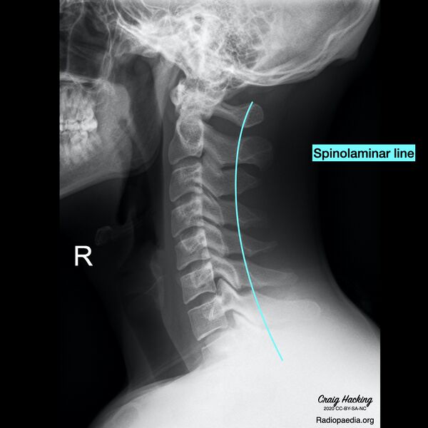 File:Cervical spine lines (Radiopaedia 76069-87571 H 1).jpeg