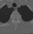 Cervical spondylolysis (Radiopaedia 49616-54811 Axial bone window 55).png