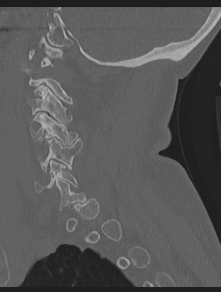 File:Cervical spondylolysis (Radiopaedia 49616-54811 Sagittal bone window 22).png