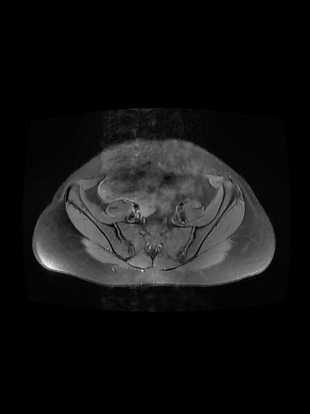 File:Cesarean section scar endometrioma (Radiopaedia 56569-63297 Axial PD fat sat 11).jpg