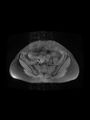 Cesarean section scar endometrioma (Radiopaedia 56569-63297 Axial PD fat sat 11).jpg