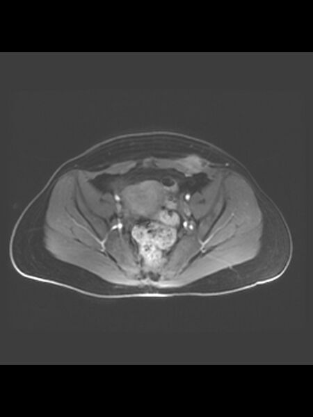 File:Cesarean section scar endometrioma (Radiopaedia 56569-63297 Axial T1 C+ fat sat 25).jpg