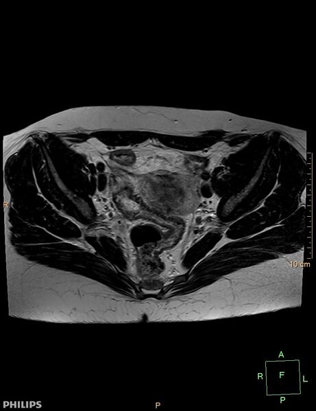 File:Cesarian scar endometriosis (Radiopaedia 68495-78066 Axial T2 10).jpg