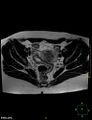 Cesarian scar endometriosis (Radiopaedia 68495-78066 Axial T2 10).jpg