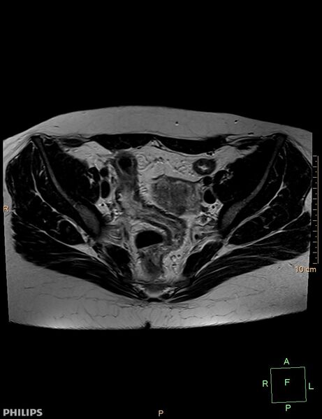 File:Cesarian scar endometriosis (Radiopaedia 68495-78066 Axial T2 9).jpg