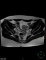 Cesarian scar endometriosis (Radiopaedia 68495-78066 Axial T2 9).jpg