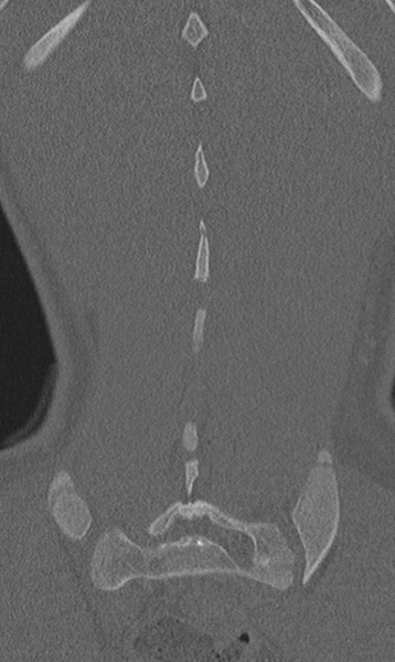 File:Chance fracture (Radiopaedia 40360-42912 Coronal bone window 61).png