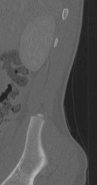 File:Chance fracture (Radiopaedia 40360-42912 Sagittal bone window 96).png