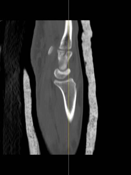 File:Chauffeur's (Hutchinson) fracture (Radiopaedia 58043-65079 Sagittal bone window 8).jpg