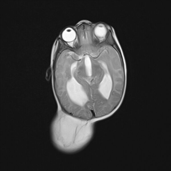 File:Chiari III malformation with occipital encephalocele (Radiopaedia 79446-92559 Axial T2 14).jpg