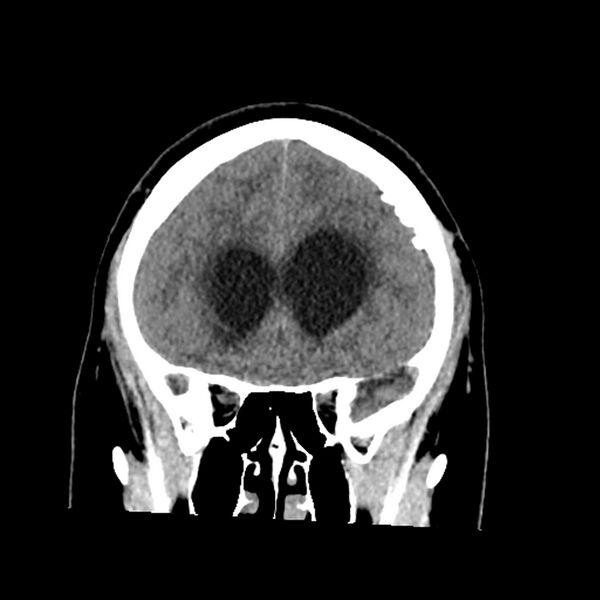 File:Chiasmatic-hypothalamic juvenile pilocytic astrocytoma (Radiopaedia 78533-91237 Coronal non-contrast 23).jpg