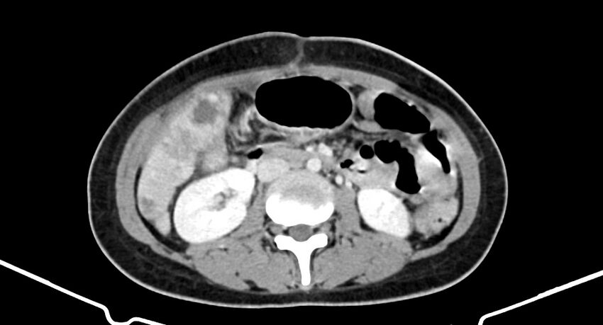 Choriocarcinoma liver metastases (Radiopaedia 74768-85766 A 107).jpg