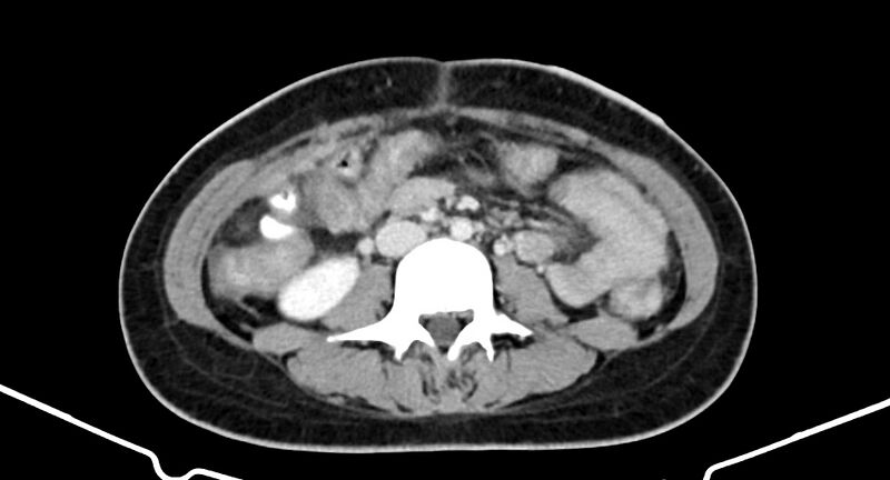 File:Choriocarcinoma liver metastases (Radiopaedia 74768-85766 A 119).jpg