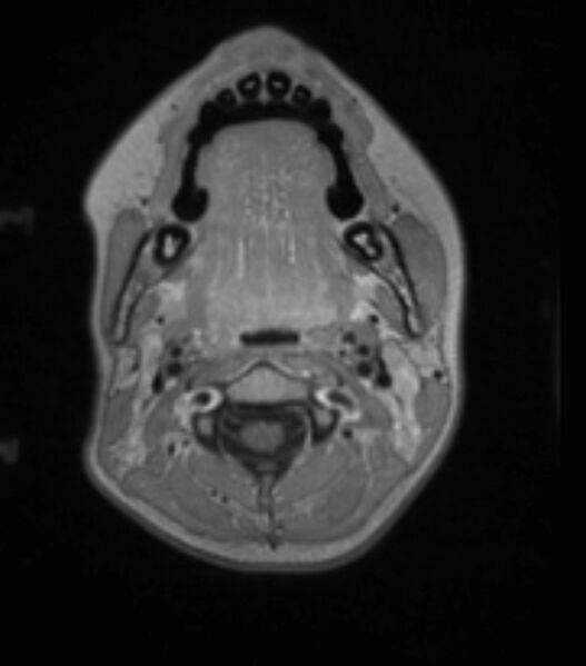 File:Choroid plexus carcinoma (Radiopaedia 91013-108553 Axial T1 C+ 42).jpg
